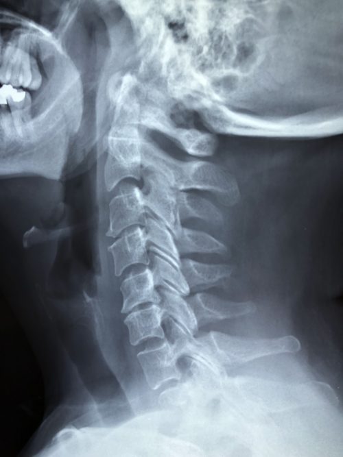 cervical x-ray choosing a chiropractor