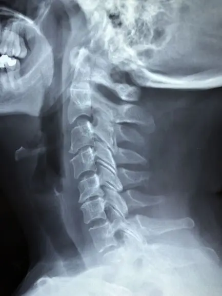 cervical x-ray whiplash