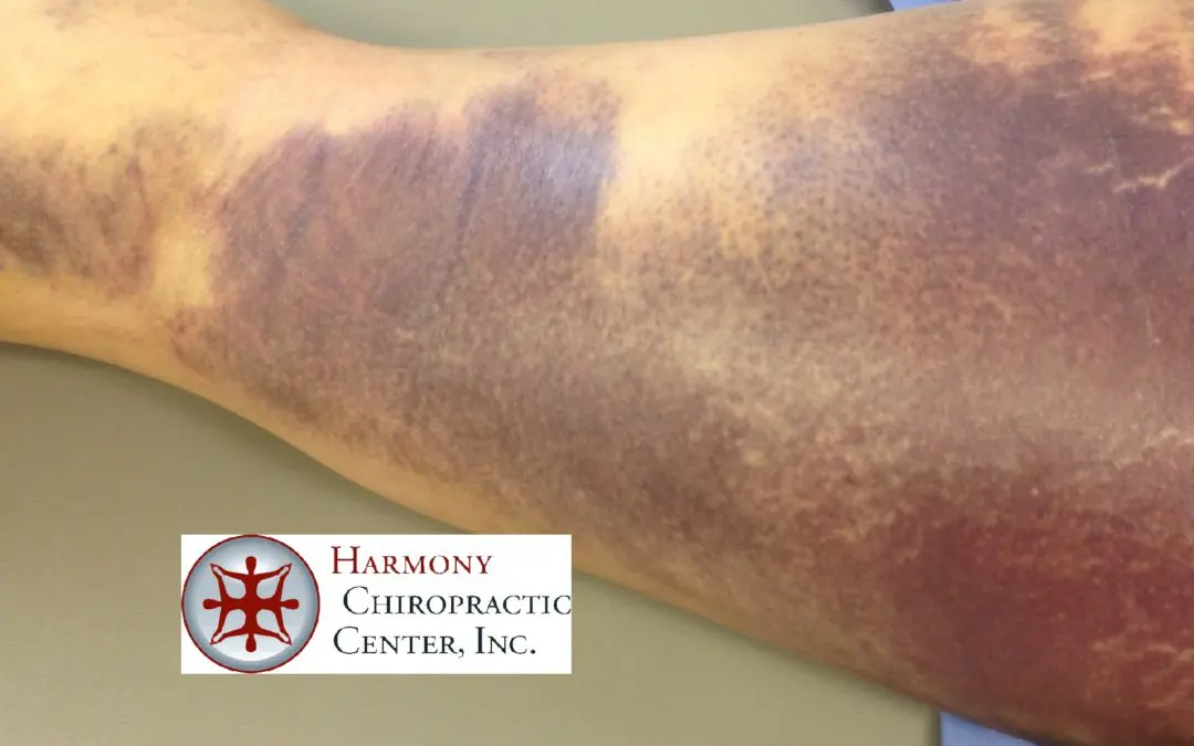 Large Bruise Drained Quickly by Kinesio Tape – Hamstring Tear