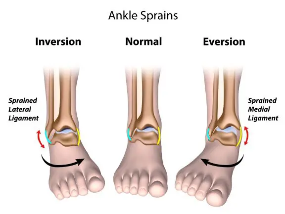 ankle and leg sprains in runners
