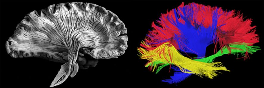 tractography in the brain 