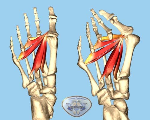 bunion formation and pain is due to poor foot biomechanics