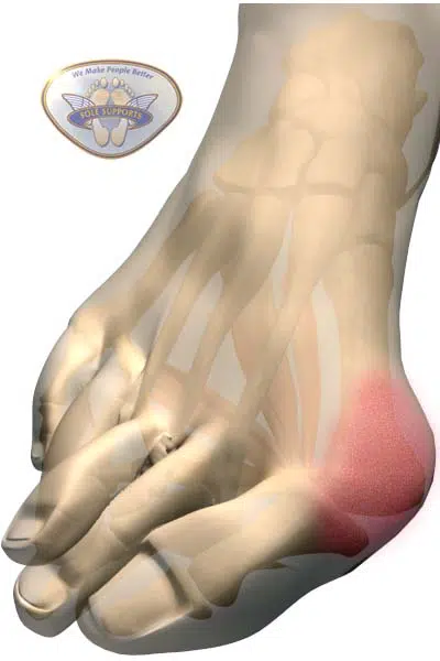 bunions can be very painful