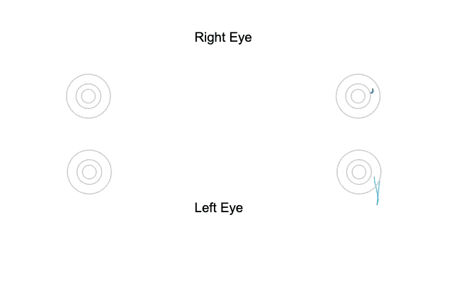 RightEye eye tracking software can find problems with saccadic eye movements.