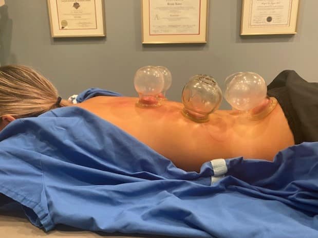 cupping therapy in Toledo OH