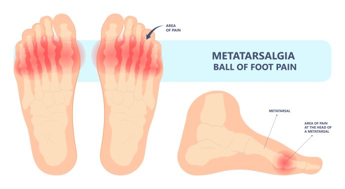 metatarsalgia foot pain Toledo, OH