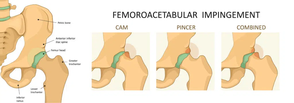 Femoroacetabular hip Impingement (fai)