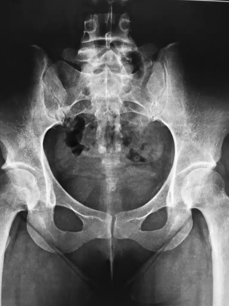 Sacroiliac joint dysfunction can cause pain and disability