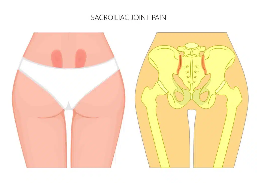 SI pain due to Sacroiliac joint dysfunction