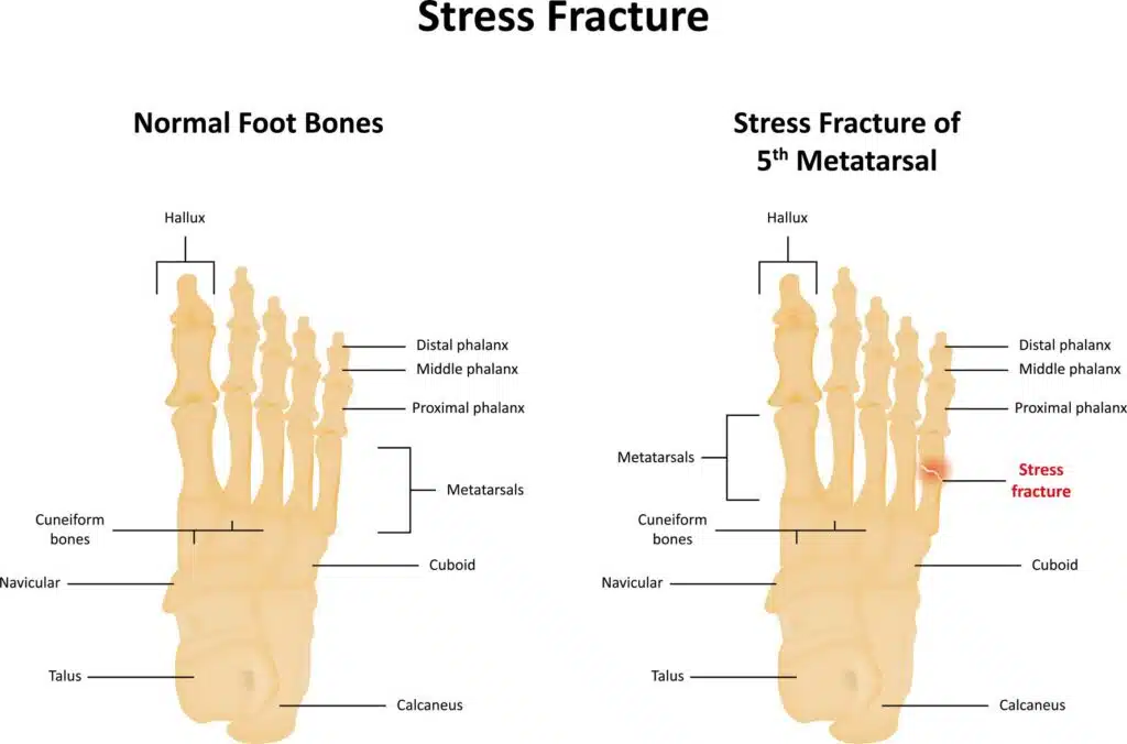 Stress Fractures in the foot